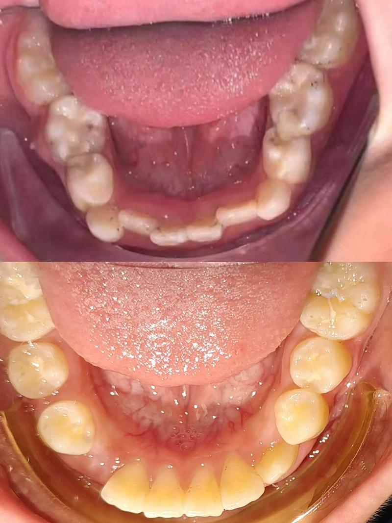 8岁儿童牙齿矫正，早干预还是等换牙？关键看哪些因素？-图2