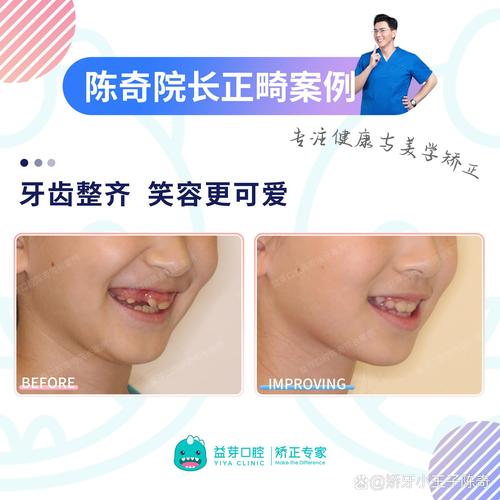 8岁儿童牙齿矫正，早干预还是等换牙？关键看哪些因素？-图3