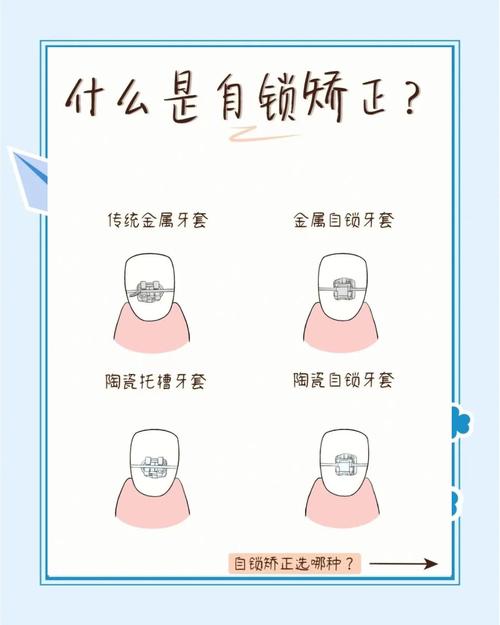 自锁矫正牙齿的原理是什么？如何实现牙齿移动？-图1