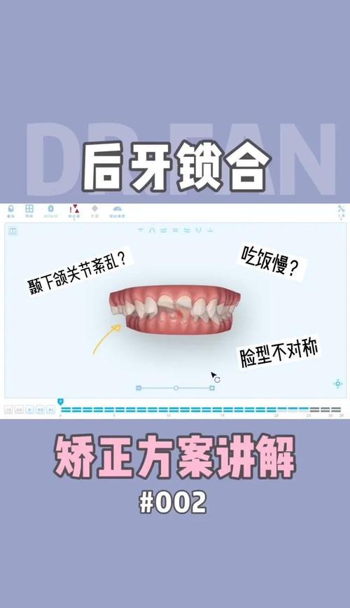 自锁矫正牙齿的原理是什么？如何实现牙齿移动？-图2