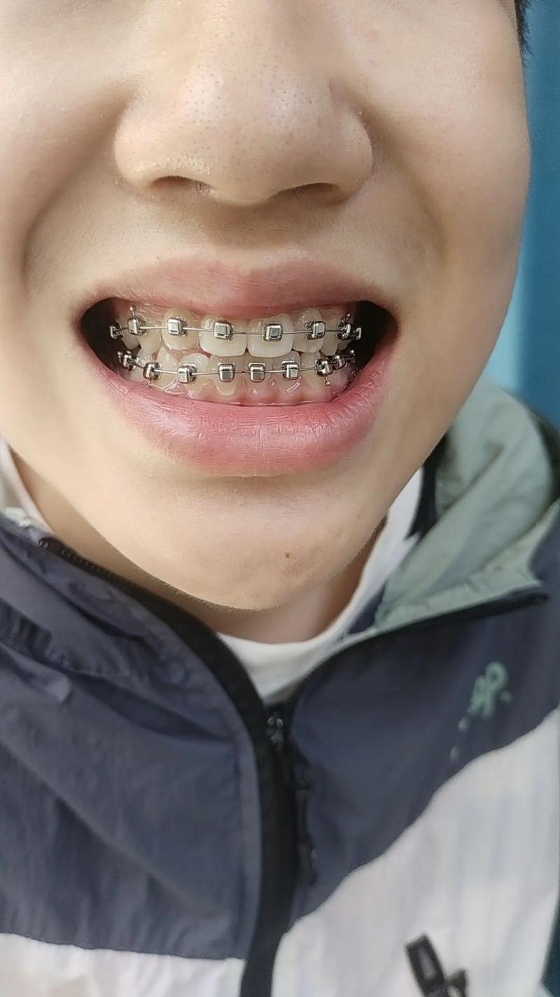 7岁儿童矫正牙齿，现在矫正时机合适吗？-图1