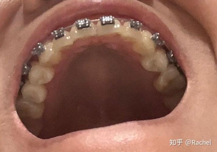 牙齿矫正单侧拔牙可行吗？会对咬合和脸型产生什么影响？-图2