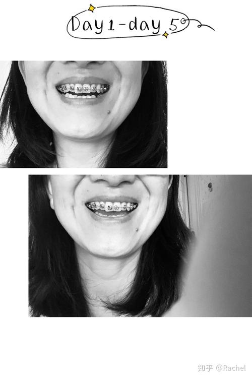 牙齿矫正单侧拔牙可行吗？会对咬合和脸型产生什么影响？-图3