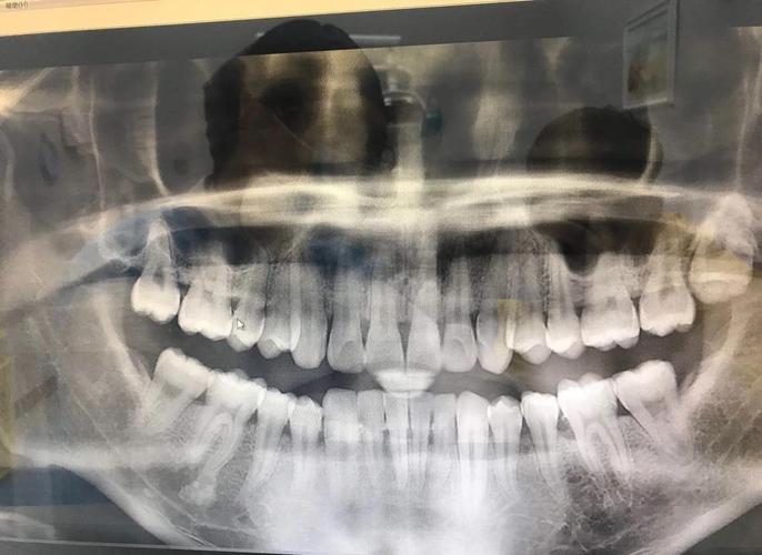 矫正牙齿拍什么片?不同片子有何作用?-图1 矫正牙齿拍什么片?不同片子有何作用?-图1