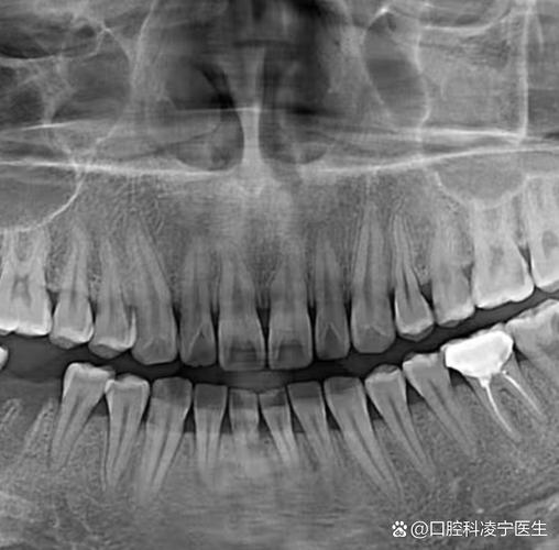 矫正牙齿拍什么片?不同片子有何作用?-图2 矫正牙齿拍什么片?不同片子有何作用?-图2