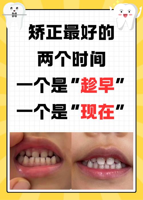 小s矫正牙齿时的年龄究竟是多少?-图3 小s矫正牙齿时的年龄究竟是多少?-图3