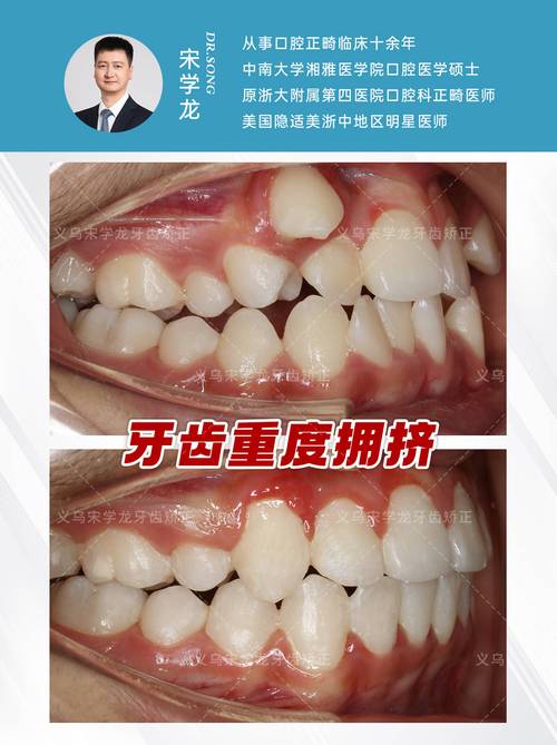 牙齿矫正如今普遍吗？矫正人群为何越来越多？-图2