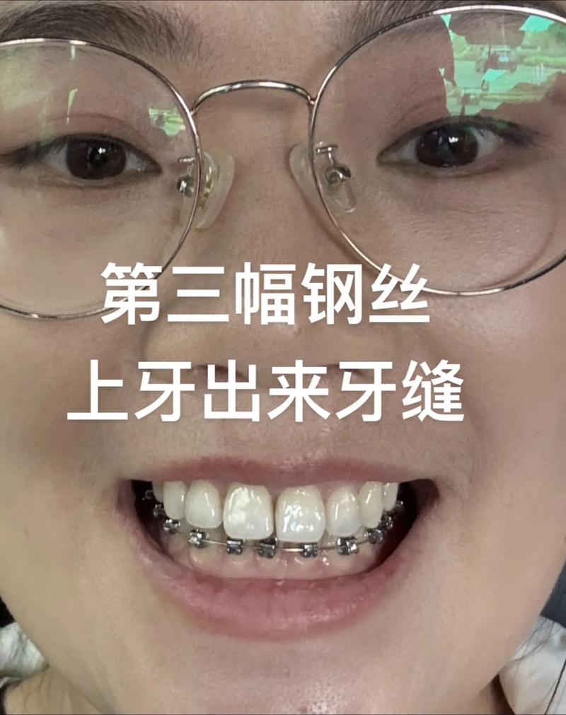 牙齿稀疏缝大矫正后，缝隙能完全消失吗？-图3