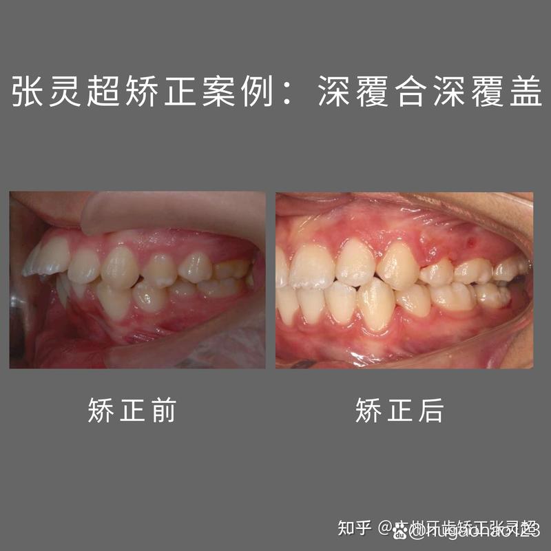 牙齿矫正抬高后牙，有何作用与注意事项？-图1