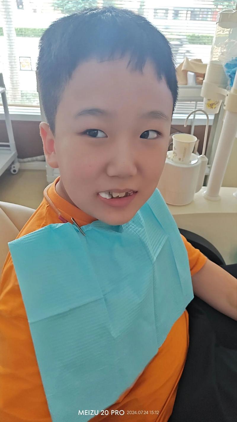 男孩牙齿矫正拔牙-图1