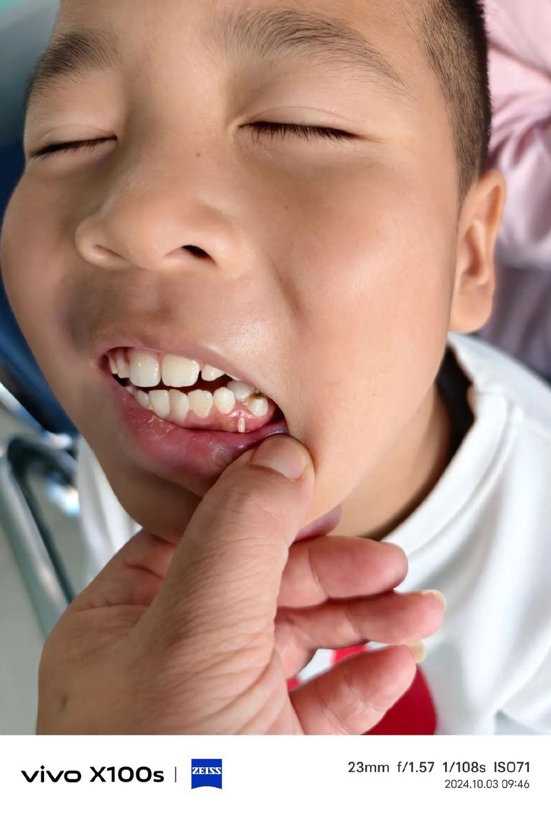 男孩牙齿矫正拔牙-图2