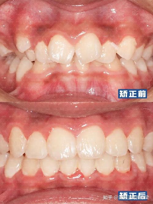 北京通州牙齿矫正哪家好?价格效果怎么样?-图3 北京通州牙齿矫正哪家好?价格效果怎么样?-图3