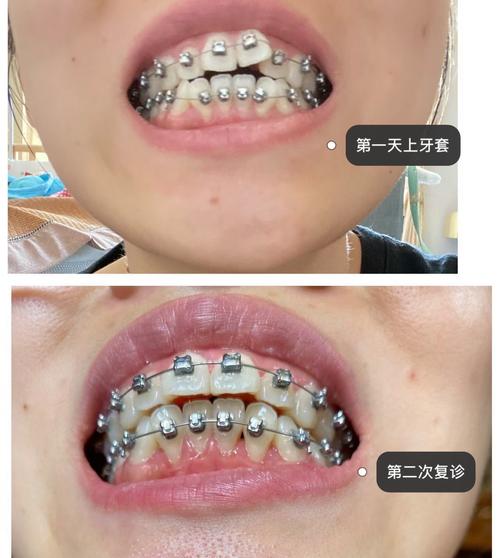 矫正牙齿是什么感觉?全程疼不疼,酸胀吗?-图3 矫正牙齿是什么感觉?全程疼不疼,酸胀吗?-图3