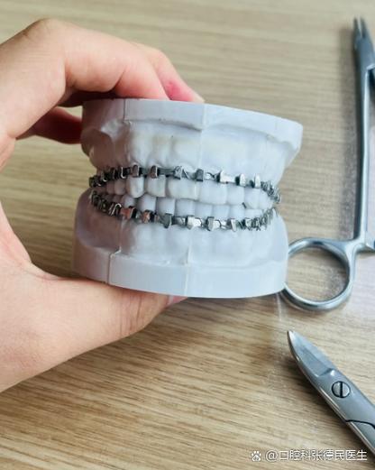 牙齿矫正托槽松动-图1 牙齿矫正托槽松动-图1