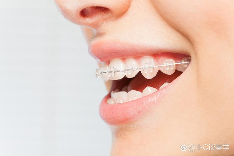 广州快速牙齿矫正效果真的快吗?靠谱吗?-图3 广州快速牙齿矫正效果真的快吗?靠谱吗?-图3