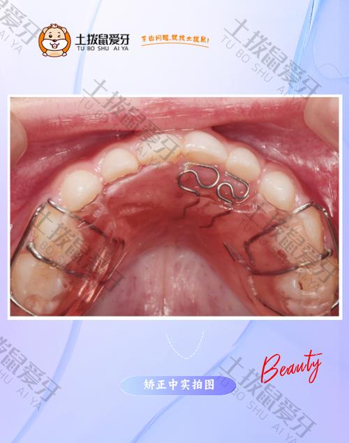 矫正牙齿为什么要上弹簧?它到底有啥用?-图1 矫正牙齿为什么要上弹簧?它到底有啥用?-图1
