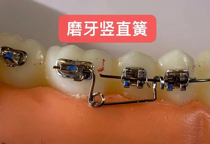 矫正牙齿为什么要上弹簧?它到底有啥用?-图2 矫正牙齿为什么要上弹簧?它到底有啥用?-图2