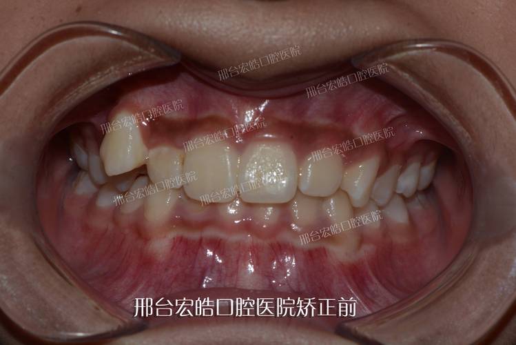 不拔虎牙矫正牙齿，效果与美观能兼顾吗？-图2