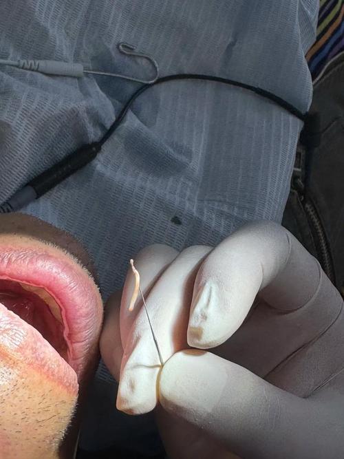 矫正牙齿为何要拔牙神经？-图1