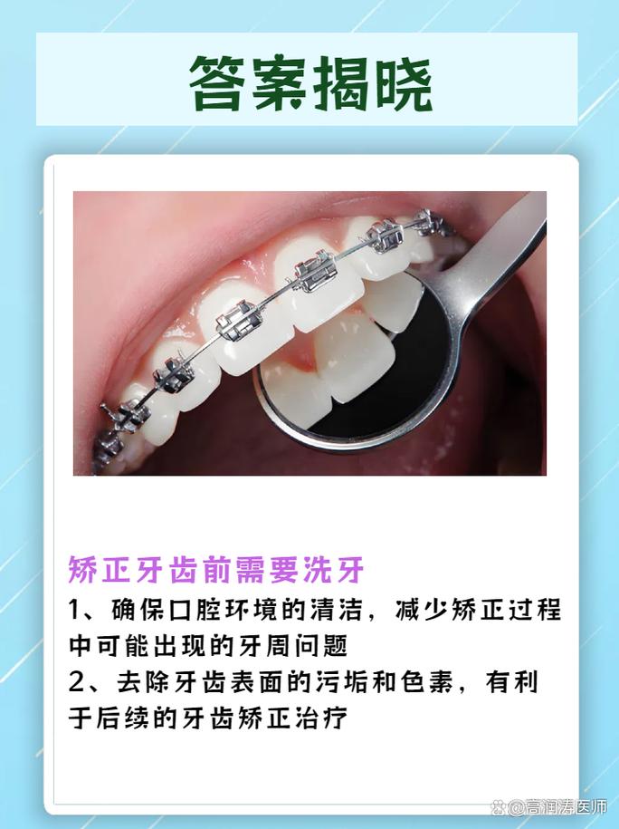 牙齿矫正前，洗牙是必须的吗？-图1