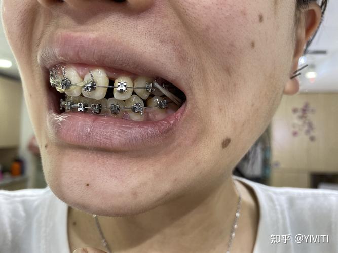 上海矫正牙齿拥挤，如何选择合适的矫正方式？-图1