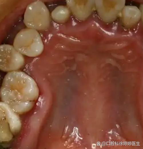 矫正期间牙齿松动正常吗？会自行恢复吗？-图2