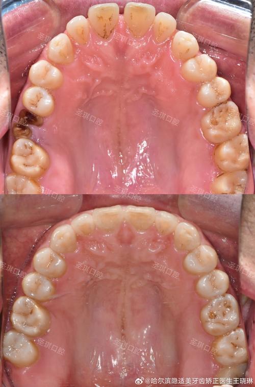 矫正完牙齿长智齿，会影响矫正效果吗？-图1