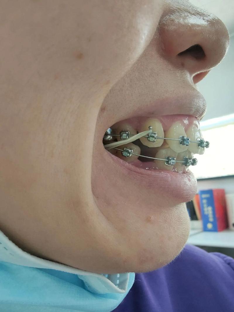 牙齿矫正有危险吗？这些潜在风险你必须知道？-图3