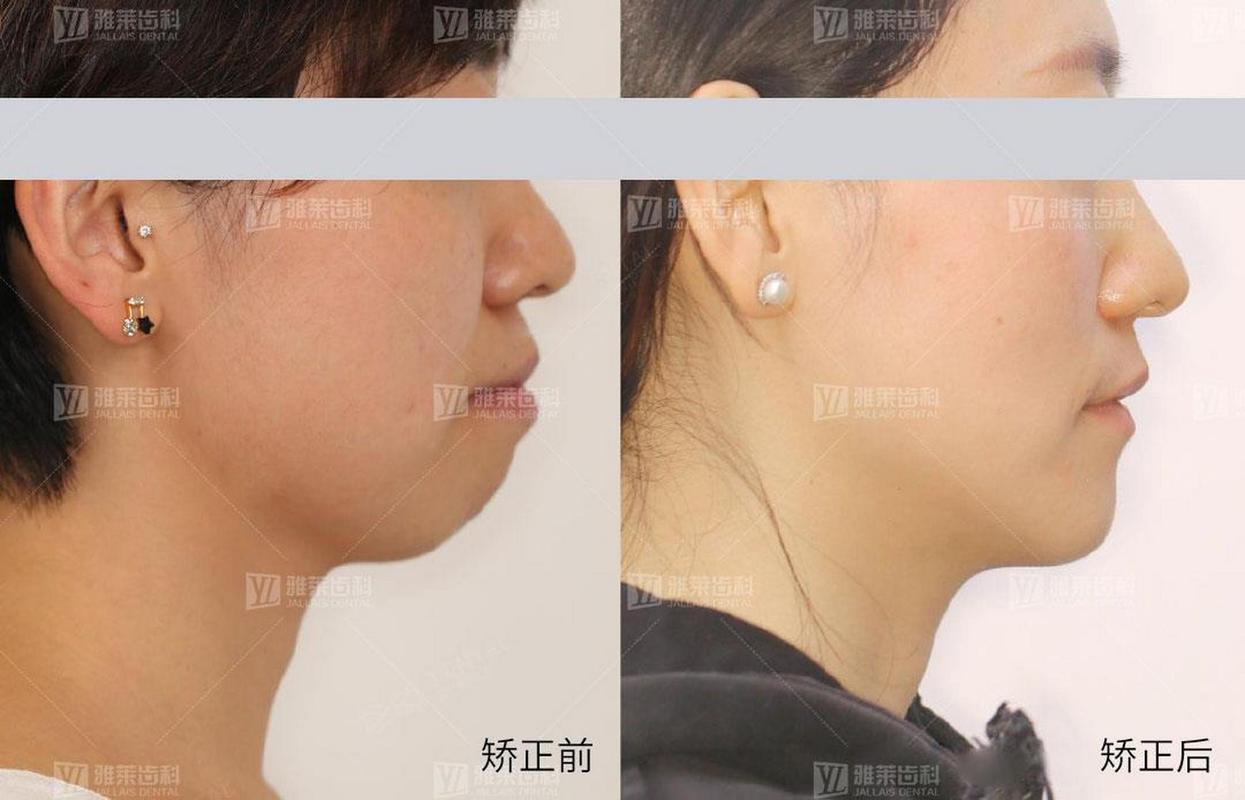 牙齿矫正侧面对比，侧脸改善效果差异明显吗？-图1