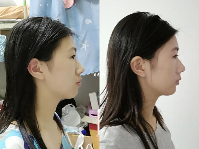 牙齿矫正侧面对比，侧脸改善效果差异明显吗？-图2