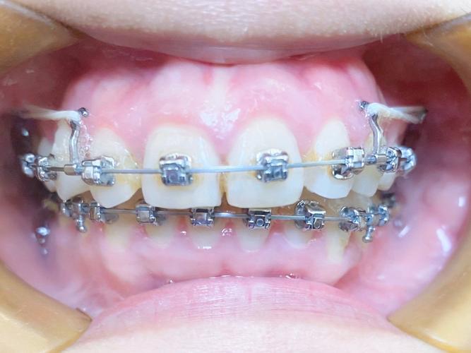 矫正牙齿用的托槽,有哪些常见类型?不同材质有何优缺点?怎么选?-图3 矫正牙齿用的托槽,有哪些常见类型?不同材质有何优缺点?怎么选?-图3