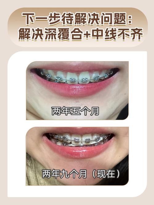 牙齿矫正要带多久-图3