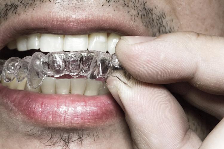 隐形托槽矫正效果如何？与传统矫正有何不同？-图3