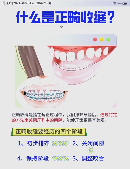 矫正牙齿收缝阶段有哪些注意事项?-图1 矫正牙齿收缝阶段有哪些注意事项?-图1