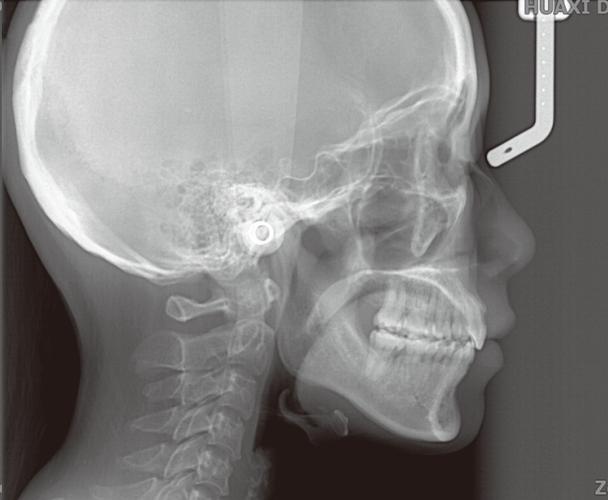 牙齿矫正为何要做头颅侧位？它对矫正方案有何关键意义？-图1