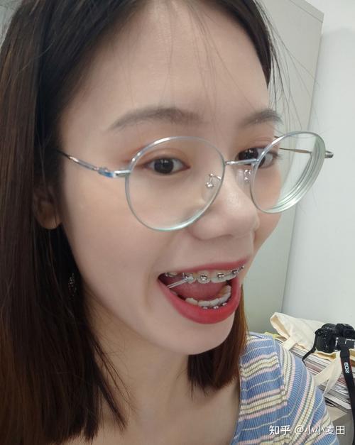 金属自锁矫正适合哪些人？效果和注意事项有哪些？-图2