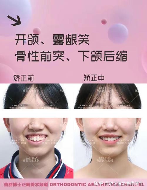 成人牙齿前突矫正-图1