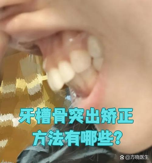 成人牙齿前突矫正-图2
