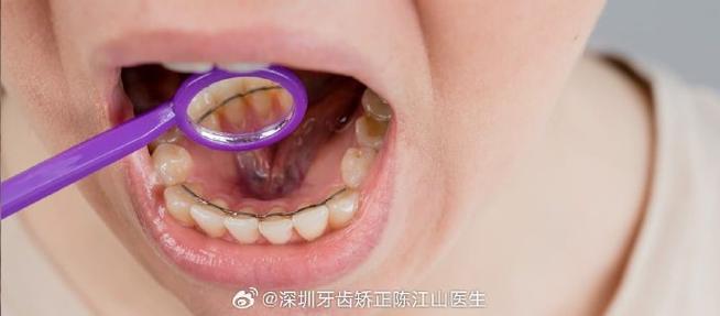 深圳矫正牙齿哪家好?求推荐靠谱医院诊所!-图2 深圳矫正牙齿哪家好?求推荐靠谱医院诊所!-图2