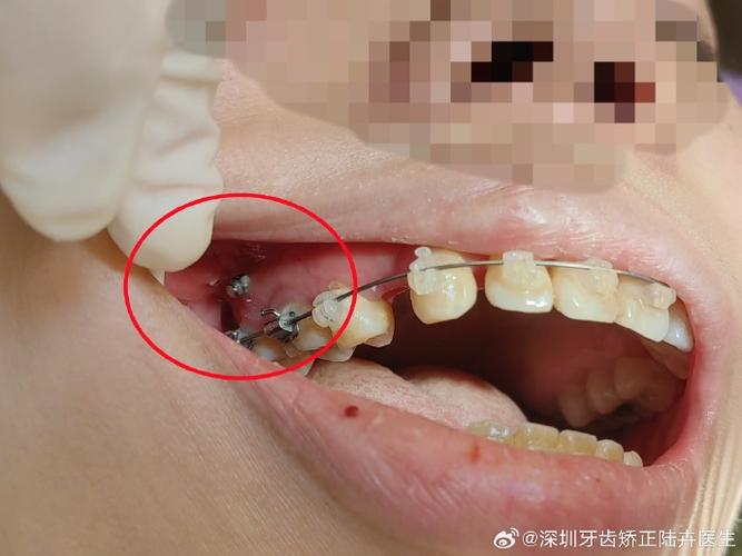深圳矫正牙齿哪家好?求推荐靠谱医院诊所!-图3 深圳矫正牙齿哪家好?求推荐靠谱医院诊所!-图3