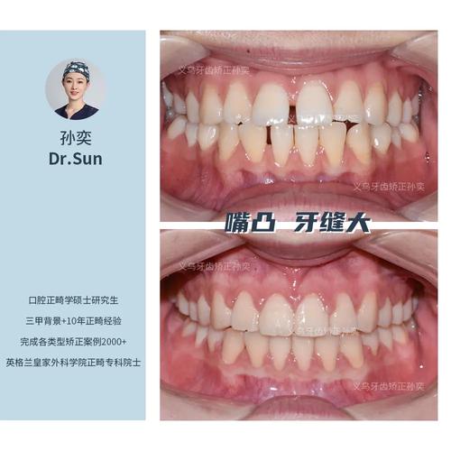 矫正牙齿后出现缝隙是正常现象吗？-图3