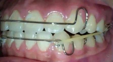 牙齿矫正拉橡皮筋，到底有什么用？怎么拉才有效？-图3