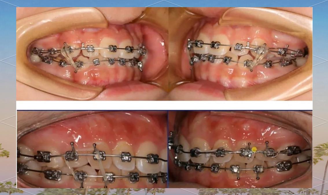 牙齿矫正二类牵引，作用、效果及注意事项？-图2