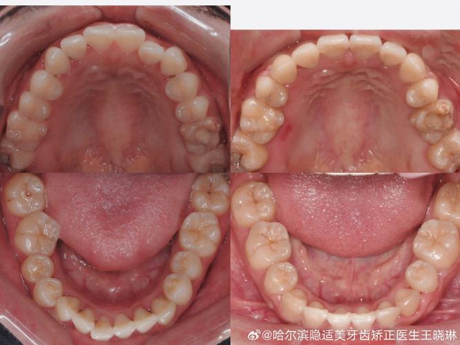 牙齿矫正拔双尖牙，真的有必要吗？会有啥影响？-图1