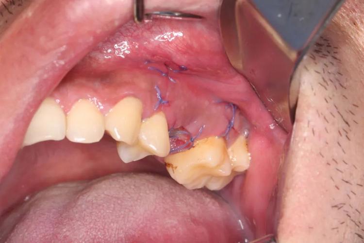 牙齿矫正拔双尖牙，真的有必要吗？会有啥影响？-图2