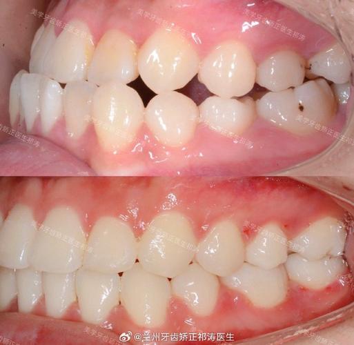 牙齿矫正为何要拔上门牙？拔牙后对美观和功能有何影响？-图3