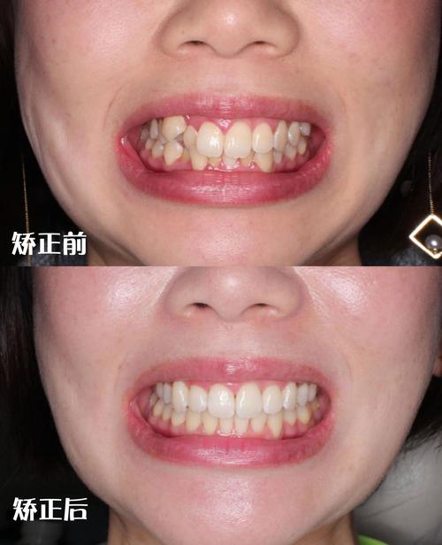矫正牙齿效果不好?原因究竟出在何处?-图3 矫正牙齿效果不好?原因究竟出在何处?-图3