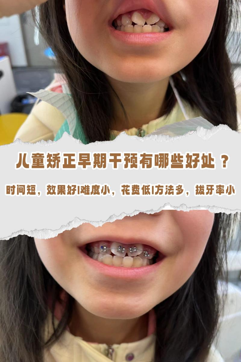 儿童牙齿矫正，几岁开始最合适？如何选方法？-图2