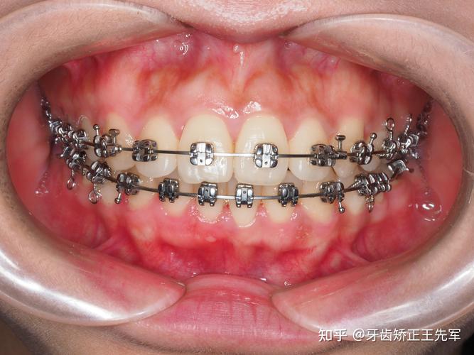 苏州成人牙齿矫正效果如何？要多久见效？-图1