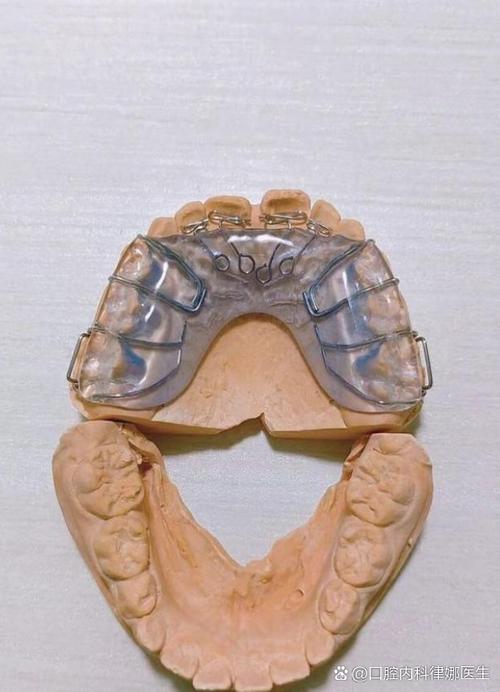 苏州成人牙齿矫正效果如何？要多久见效？-图3